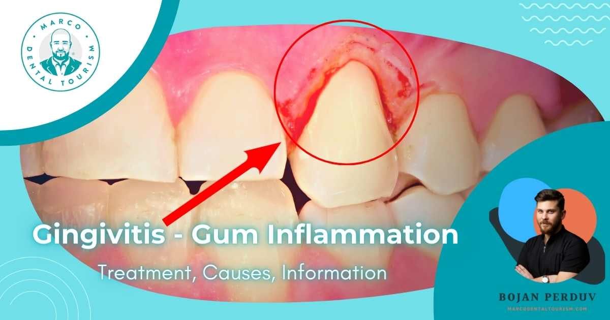 Gingivitis: Inflammation of the gums | Treatment, Causes