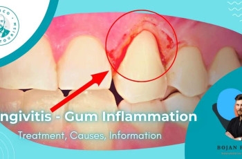 Gingivitis: Inflammation of the gums | Treatment, Causes marco dental tourism