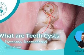 Cysts on the Teeth marco dental tourism