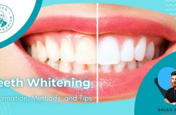 Teeth Whitening: Information, Methods, and Tips marco dental tourism