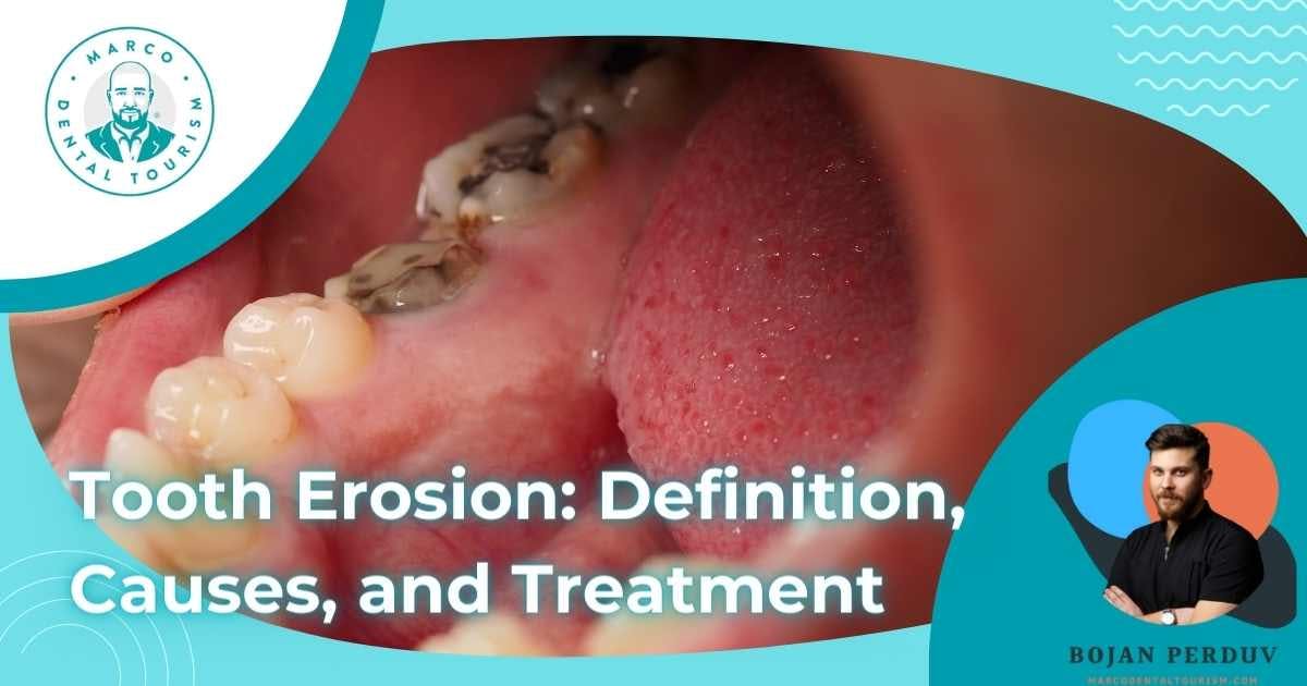 Tooth Erosion: Definition, Causes, and Treatment