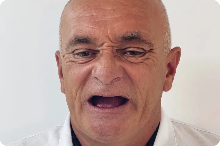 All On 4 usluga na našem zadovoljnom pacijentu