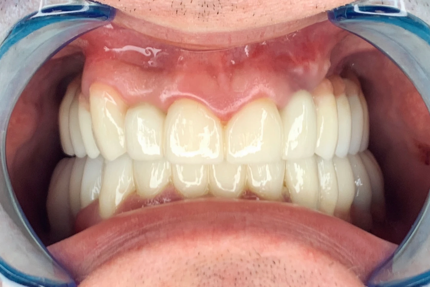 Alen's smile after All-on-4 treatment