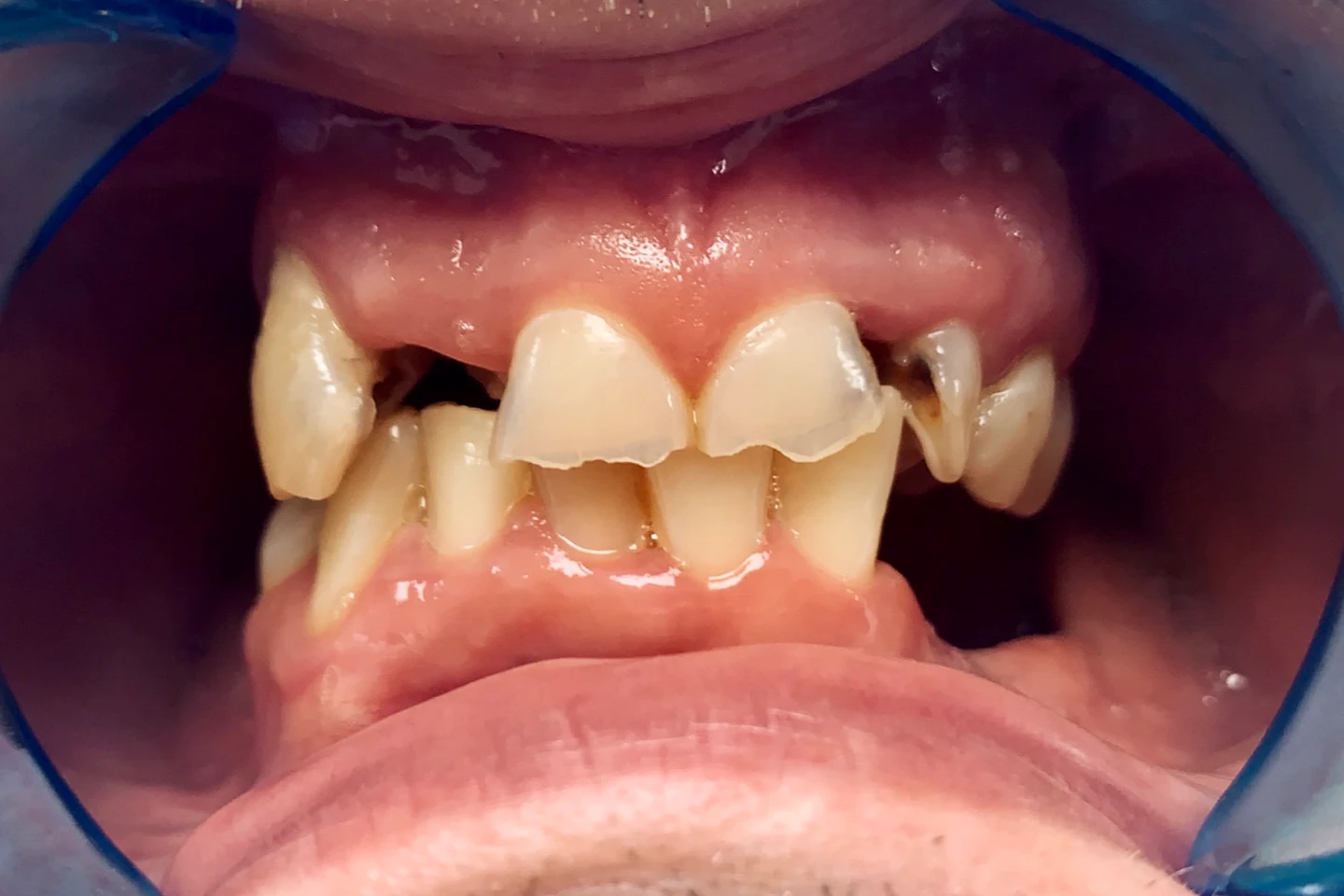 Alen's smile before All-on-4 treatment