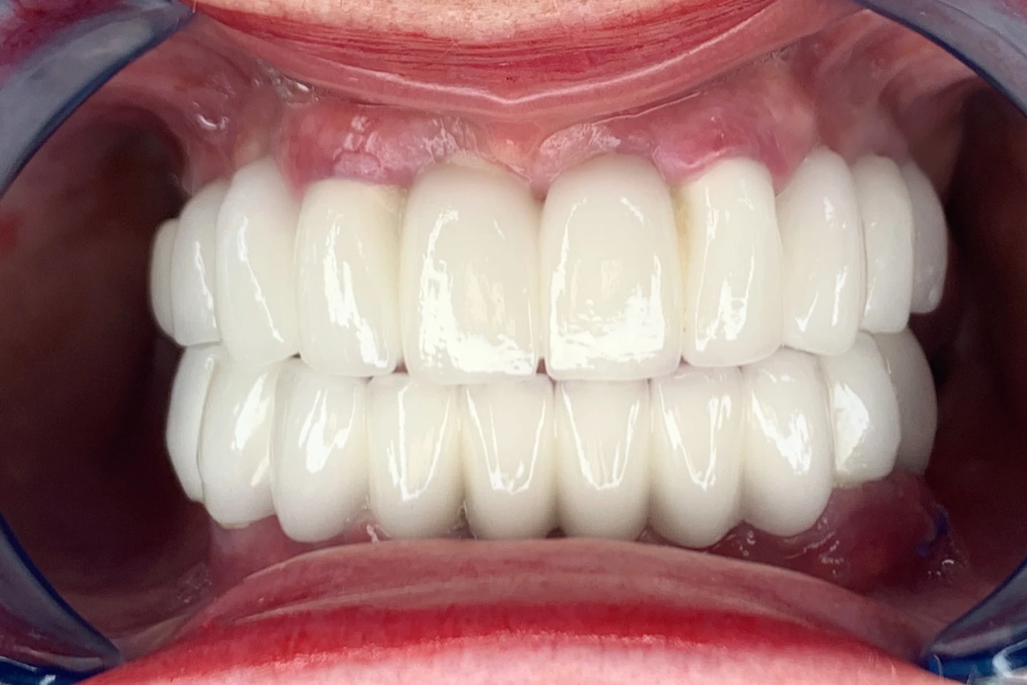 Mara's smile after All-on-4 treatment