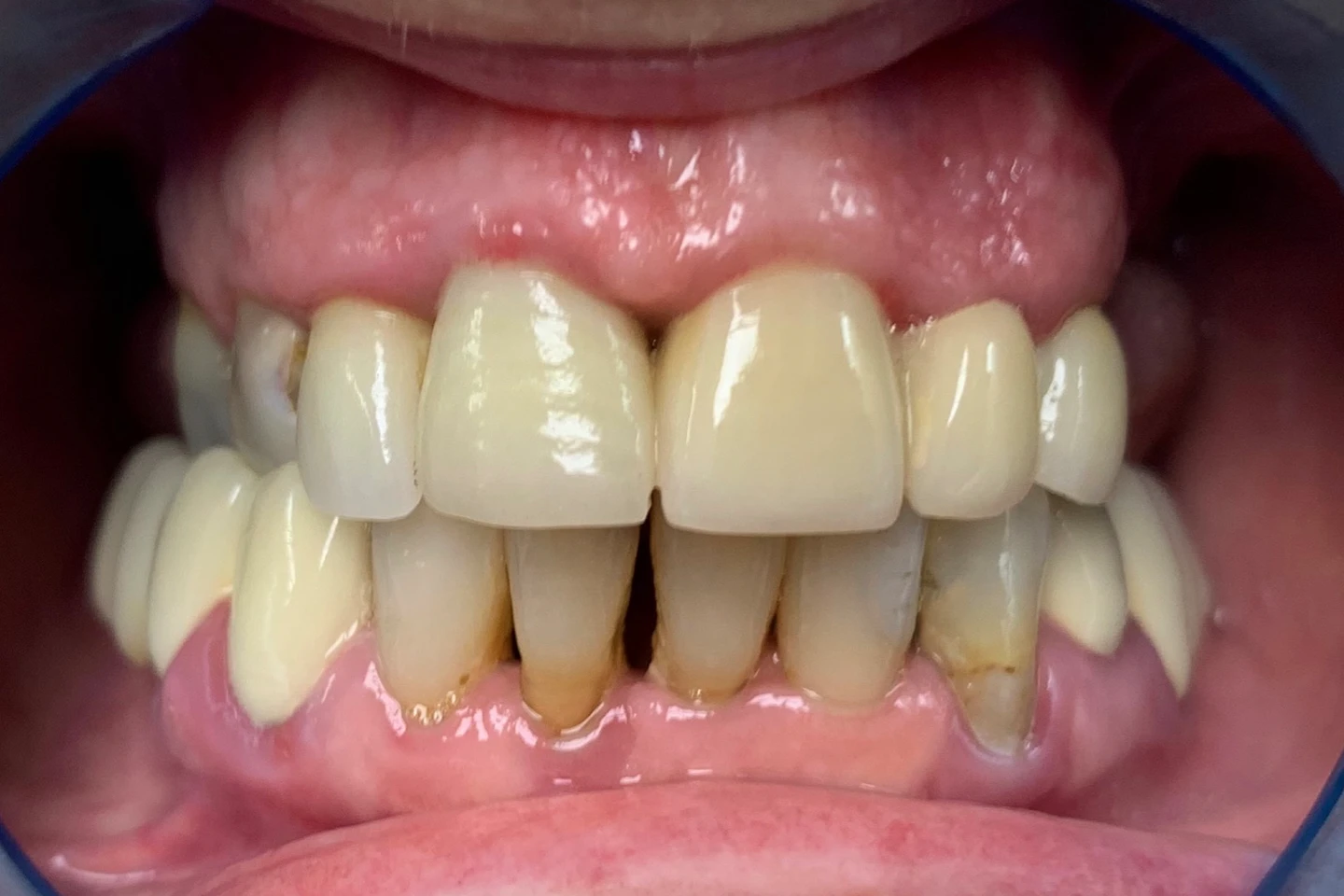 Mara's smile before All-on-4 treatment