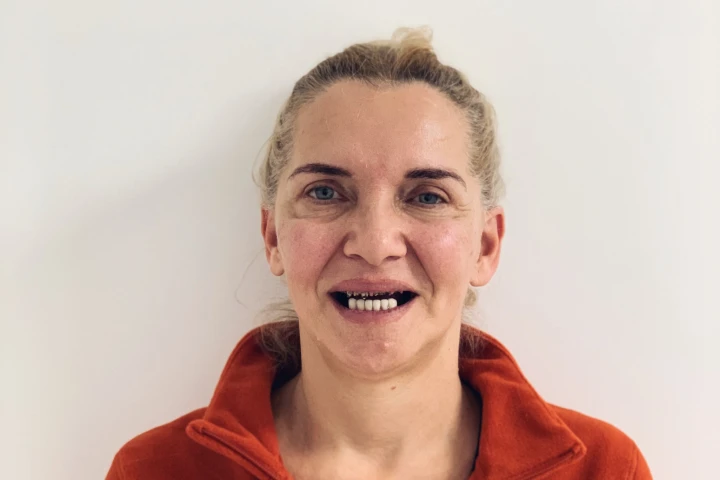Rada's smile before All-on-4 treatment
