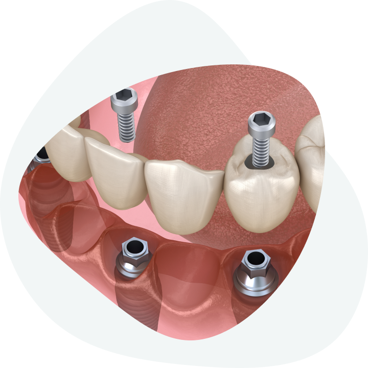 Koliko traje ugradnja implanta zuba?